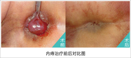 痔疮手术对比图
