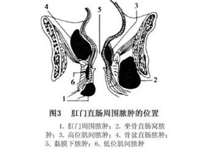 肛周脓肿的类型及发病位置