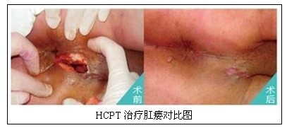微创术治疗肛瘘