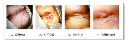而对肛门括约肌功能影响较大的肛瘘,则采取挂线疗法