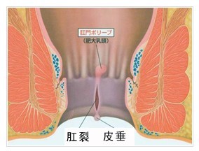 >>>>>具有相同或者相似的症状?肛门疼痛,便血会是肛门裂口吗?    