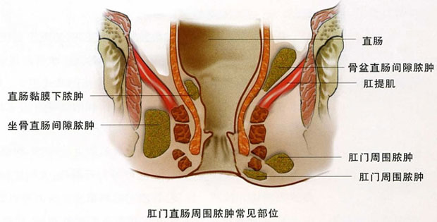 肛周囊肿