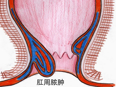 肛周脓肿症状