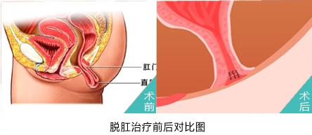 脱肛治疗