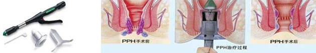 微创手术