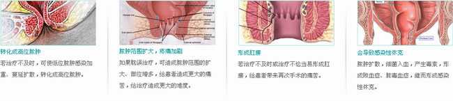 肛周脓肿危害