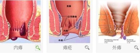 痔疮