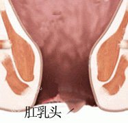 肛乳头瘤