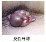 炎症性外痔