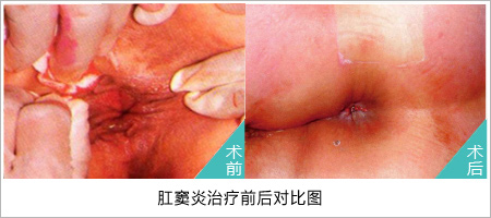 肛窦炎