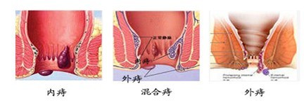 痔疮的