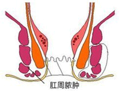肛周脓肿原因