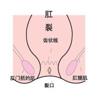 肛裂病因