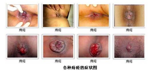 痔疮症状