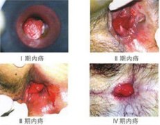 内痔症状