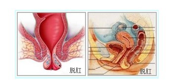 脱肛症状