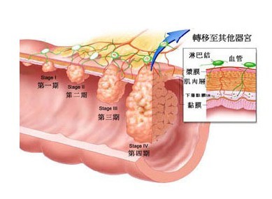 肠息肉分期