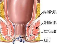 肛乳头瘤
