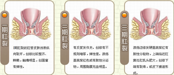 肛裂分期
