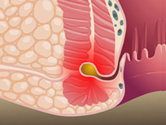 预防肛瘘