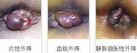 外痔分类