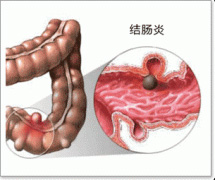 结肠炎