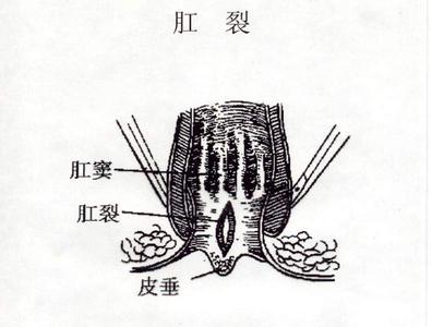 预防肛裂