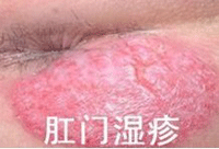 肛门湿疹
