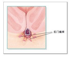 肛门瘙痒危害