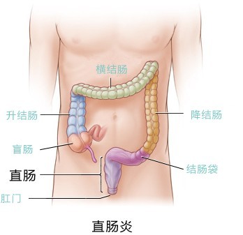 直肠炎病因