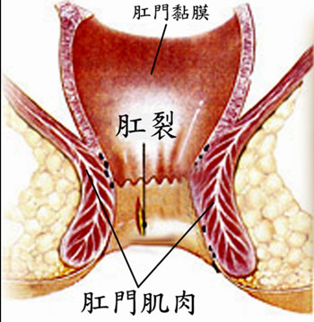 肛裂不能自愈的原因