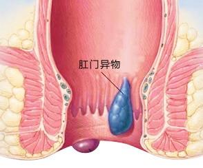 肛周脓肿原因