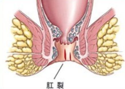 便血原因