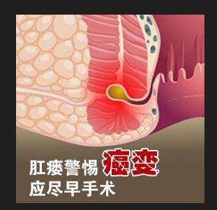 肛瘘严重吗?