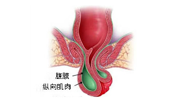 脱肛表现