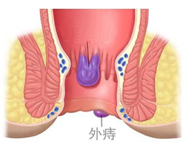 外痔预防
