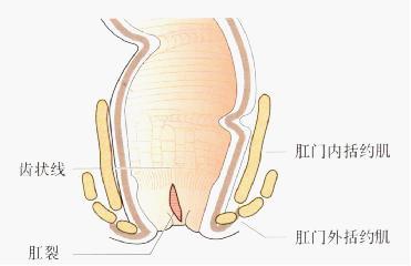肛裂发作原因