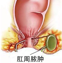 肛周脓肿危害