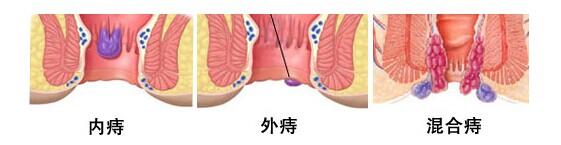 痔疮分类