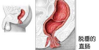直肠脱垂