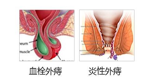 外痔分类