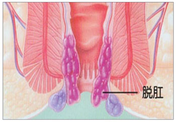 脱肛预防