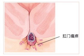 肛门瘙痒症状