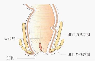 肛瘘不能自愈原因