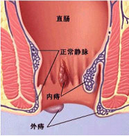 痔疮症状