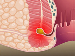 肛瘘原因