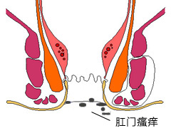 肛门瘙痒护理
