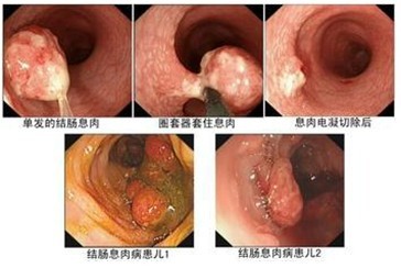 肠息肉