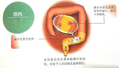 息肉