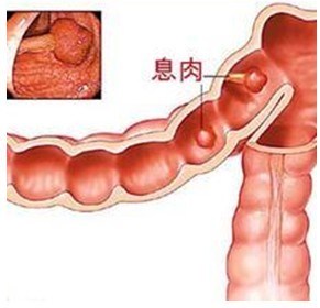 肠息肉症状